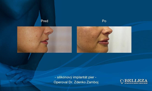 Výsledky zväčšenia pier