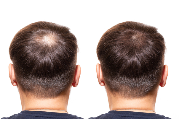 Vlasová mezoterapia je účinná v boji proti vypadávaniu vlasov