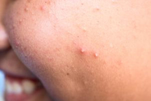 Výber lekára na liečbu akné