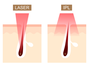 IPL epilácia - foto epilácia svetlom