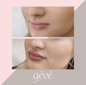 Ako zistím, že som vhodný kandidát pre lifting pier?