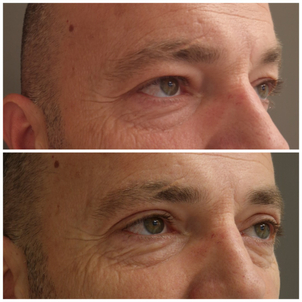 Blepharoplastika