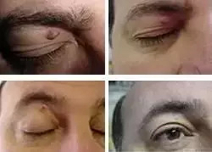 Príprava na ošetrenie výrastkov laserom