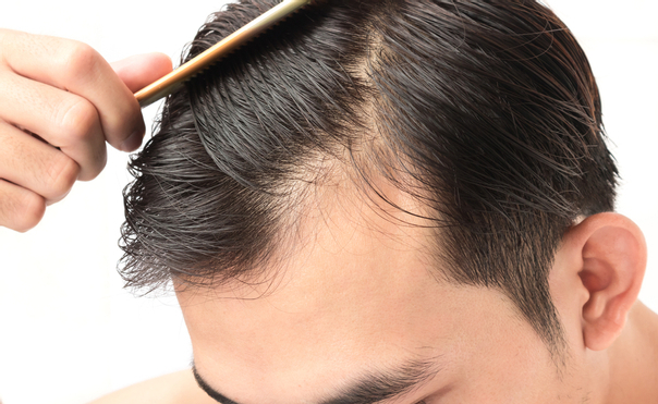 Riziká vlasovej mezoterapie sú ojedinelé a mierne