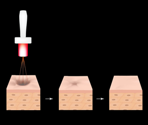 Odstránenie jaziev laserom