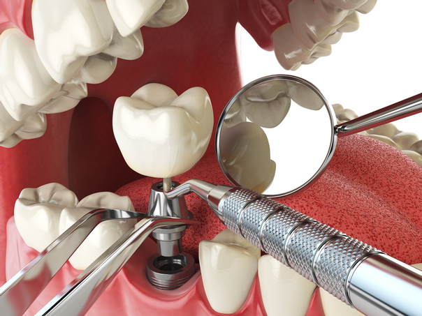 Materiál náhradných zubov