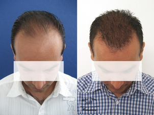 Pred po fotky po transplantácii vlasov