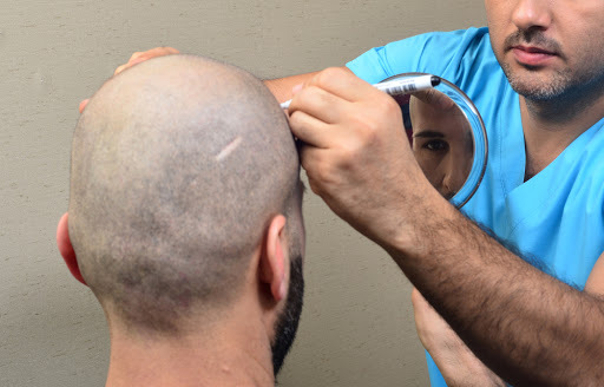 Špecialista musí zhodnotiť rozsah vypadávania vlasov a stupeň alopécie
