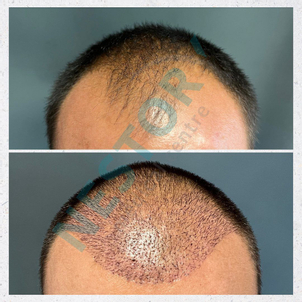 Transplantácia vlasov