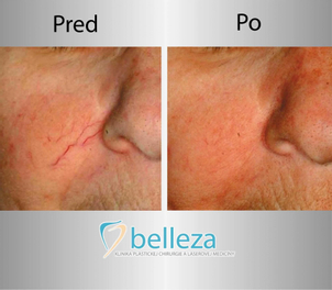 pred a po odstránenie žiliek laserom