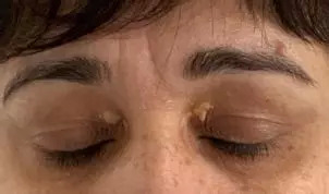 Som vhodný kandidát pre odstránenie xantelaziem?