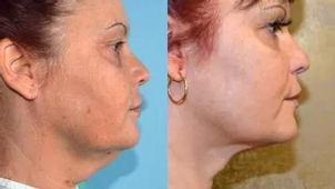 Rekonvalescencia po liposukcii