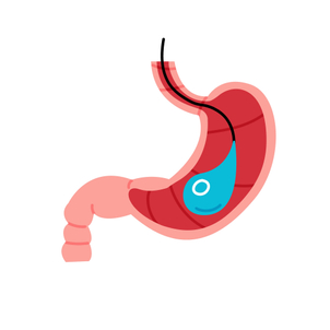 Čo je to endoskopické zavedenie intragastrického balóna BIB?