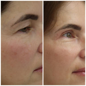 Rany sú po operácii chránené tenkými náplasťami