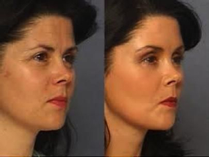 Indikácia, kto je vhodný pre tento zákrok