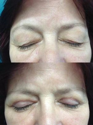 Blepharoplastika