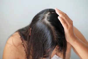 Vypadávanie vlasov postihuje aj ženy