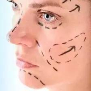 Ako prebieha zotavenie po profiloplastike