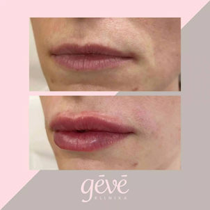 Zväčšenie pier kyselinou hyalurónovou