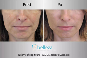 Ako prebieha zotavenie po niťovom liftingu