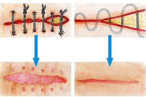 Schéma chirurgickej korekcie jazvy