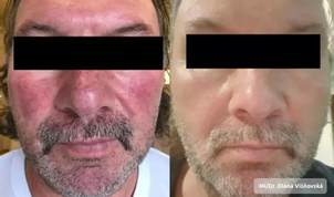 Ako prebieha zotavenie a rekonvalescencia po anti-aging ošetreniach?