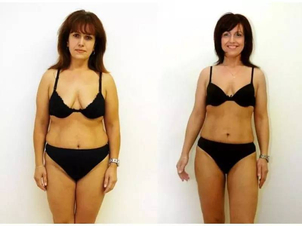 Ultrazvuková liposukcia - UAL (ultrasonic - assisted liposuction)