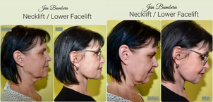 Tvárový lifting pred a po