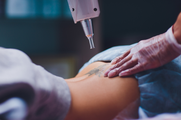 Ako sa vykonáva laserové odstránenie tetovania?