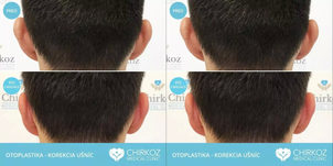 Pred a po otoplastike