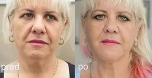 Ako zistím či som vhodný kandidát na niťový lifting?