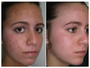 Ako sa zbaviť akné: laserová liečba akné