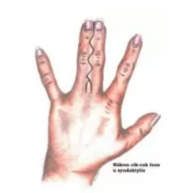 Syndaktylia (zrast prstov)