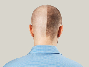 Transplantácia vlasov