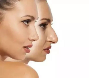 Rhinoplastika