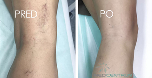 Výsledok ošetrenia metličkových žiliek (foto archív lekára)