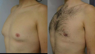 Čo je to gynekomastia?