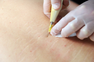 Výhody karboxyterapie