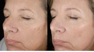 Používa sa CO2 laserový resurfacing len na omladenie tváre?