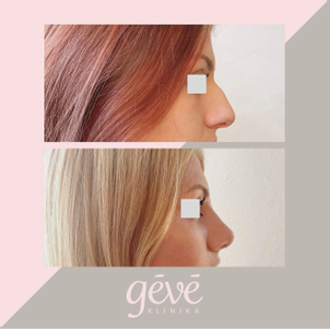 Výsledky rhinoplastiky