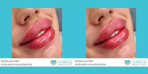 Ako prebieha zotavenie po zväčšení pier