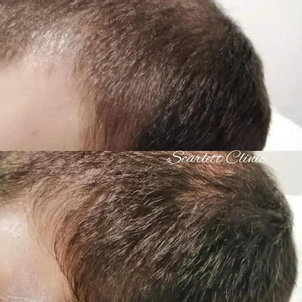 Výsledky plazmaterapie