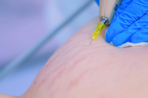 Čo je karboxyterapia?