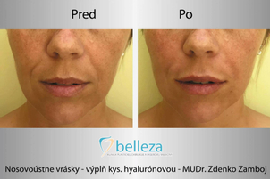 Výsledky neinvazívneho liftingu tváre