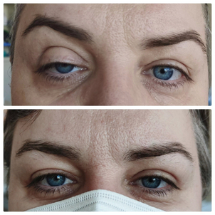 Priebeh operácia očných viečok