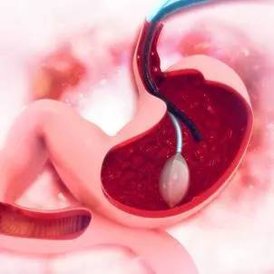 Ako sa vykonáva endoskopické zavedenie intragastrického balóna BIB