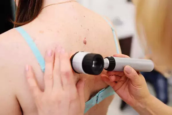 Pri vyšetrovaní znamienok sa najčastejšie používa dermatoskop