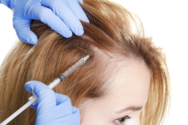 Vlasová mezoterapia patrí medzi často používané liečebné metódy pri vypadávaní vlasov