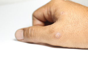 Ako zistím či som vhodný kandidát na liečbu bradavíc (verrrucae)?