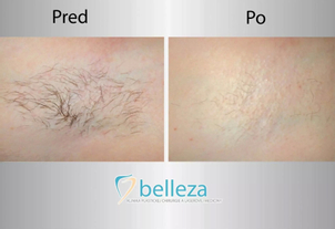 Výsledky laserovej epilácie